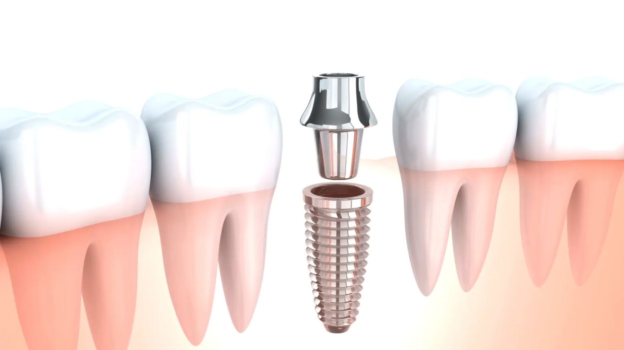 Implant component 