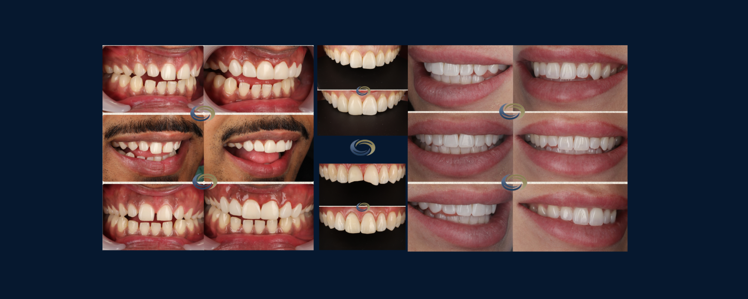 Dental Veneers